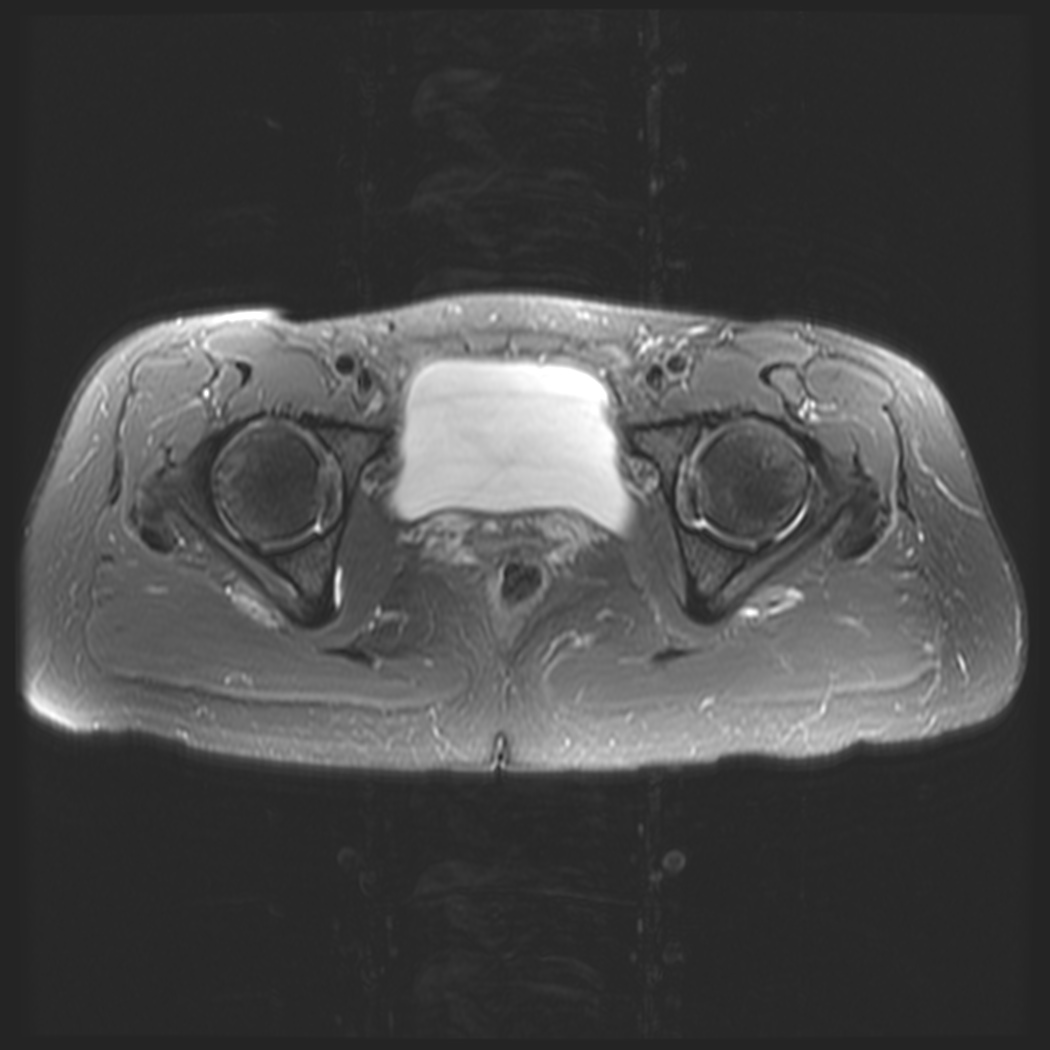Figure 2 for case obturator internus bursitis ( RID2633 )